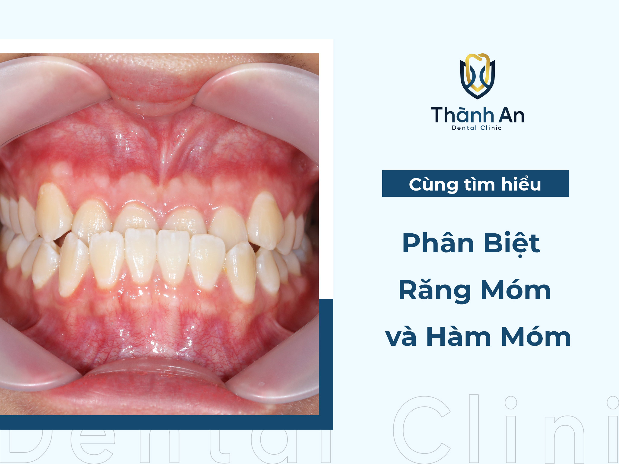 Phân biệt răng móm và hàm móm theo tiêu chí nào? Phân biệt răng móm và hàm móm theo tiêu chí nào?